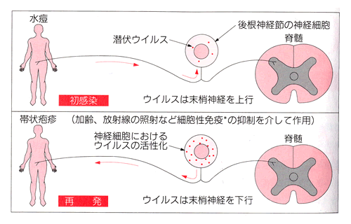 潜伏したウイルスが帯状疱疹を発症させる機序の説明図