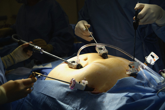 腹腔鏡手術の画像