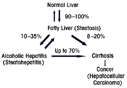 脂肪肝から肝炎　肝硬変に進展する頻度