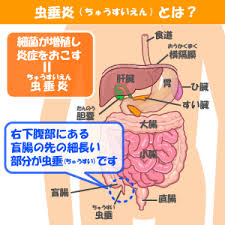 急性虫垂炎の説明図