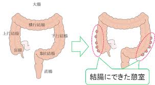 大腸憩室が起こる部位を示した図