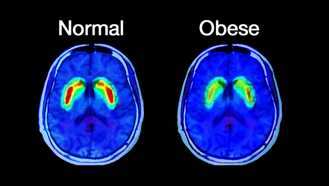 肥満したヒトでは脳内のドパミンの放出　ドパミン受容体発現が低下していることを示す図