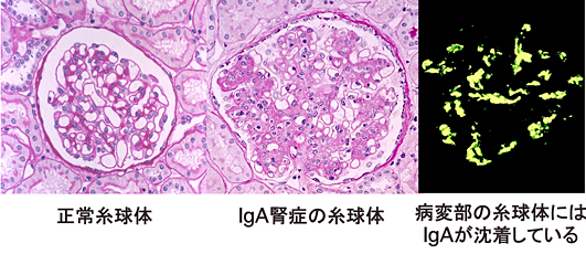 IgA腎症の顕微鏡写真