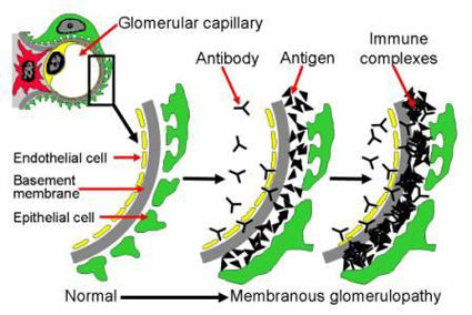 膜性腎症の糸球体の病変を解説する図