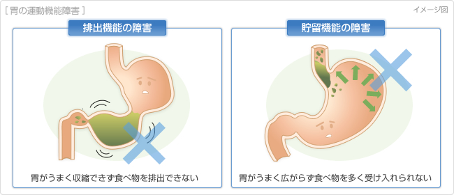 胃の排出遅延の説明図