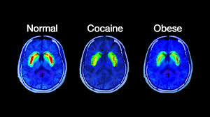 機能的MRIで示された肥満の人の脳内で不足しているドーパミン