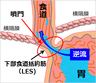 LESの機能低下と胃酸逆流の関係を示した図
