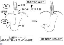 下部食道括約筋（LES）の機能強化術の手順をまとめた図