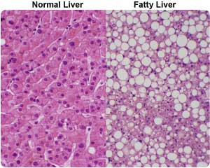 脂肪肝の組織像