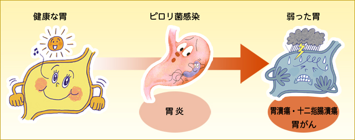 ピロリ菌が感染した胃における萎縮性胃炎から胃がんへの進行