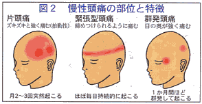 頭痛が起こる場所による頭痛の種類の鑑別