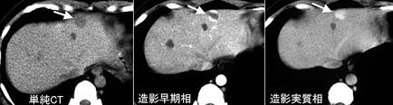 肝血管腫の造影CT像