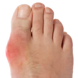 痛風発作で赤くなって腫れた足の親指の付け根の写真
