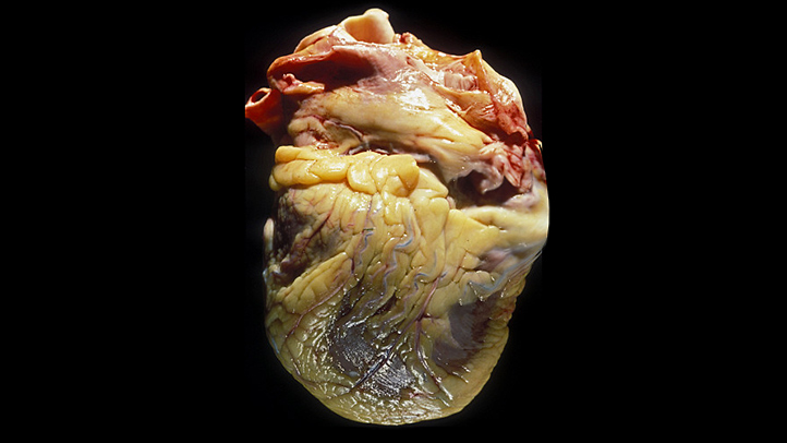 心臓に蓄積した異所性脂肪の写真