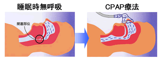 CPAP療法の解説図