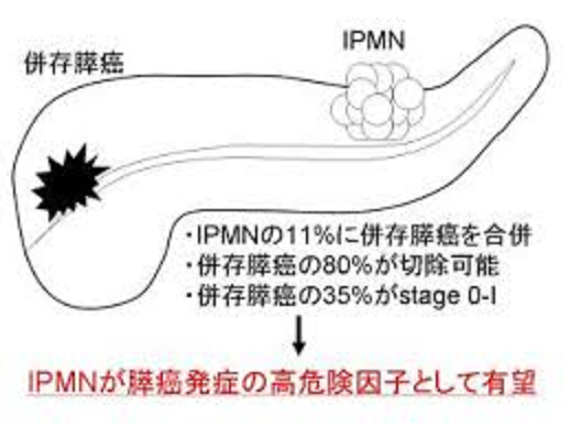 IPMNとは別の部位に通常の膵がんが発生することを示す図