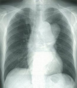 胸部レントゲンで観察される大動脈弓突出影