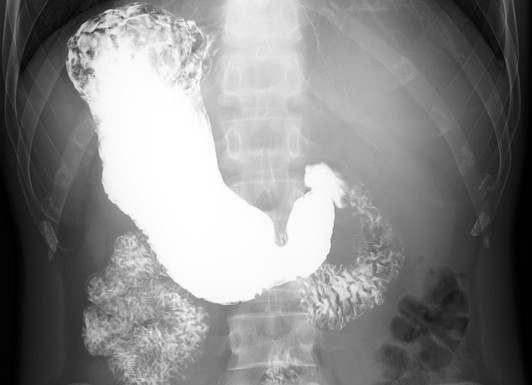 胃バリウム検査の画像