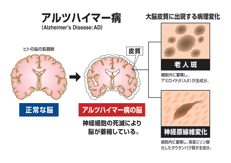 アルツハイマー病の脳で老人斑が蓄積することを示す図