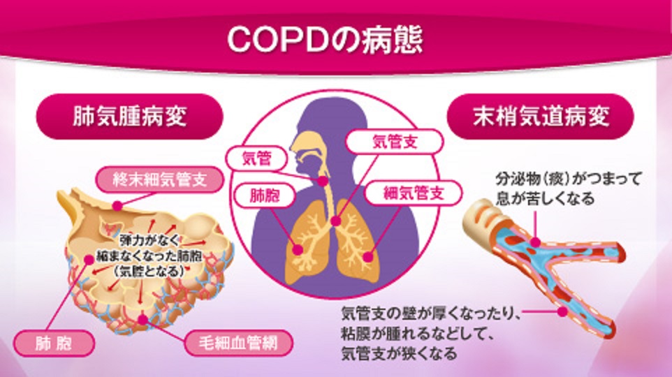 COPDの肺のさまざまなレベルで病理的変化を示す図