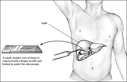 肝生検の説明図