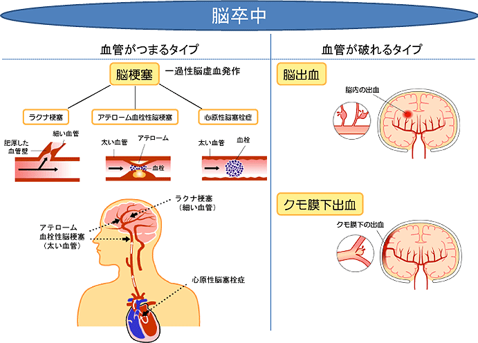 出血性脳卒中とは何ですか?