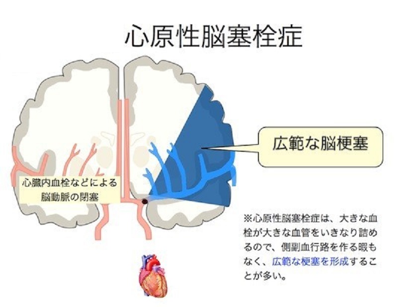 心原性脳塞栓症が大きな梗塞を引き起こすことを示す図