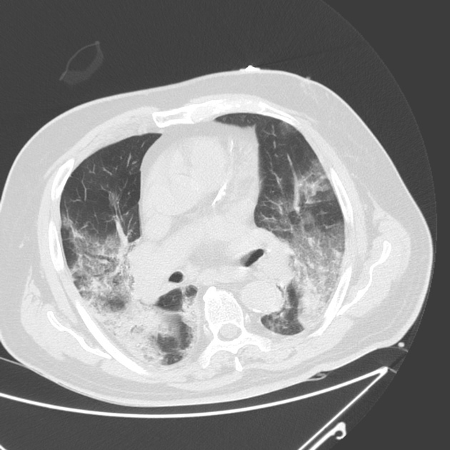 COVID19により起きた肺炎のCT画像