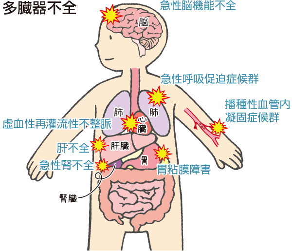 多臓器不全について説明した図