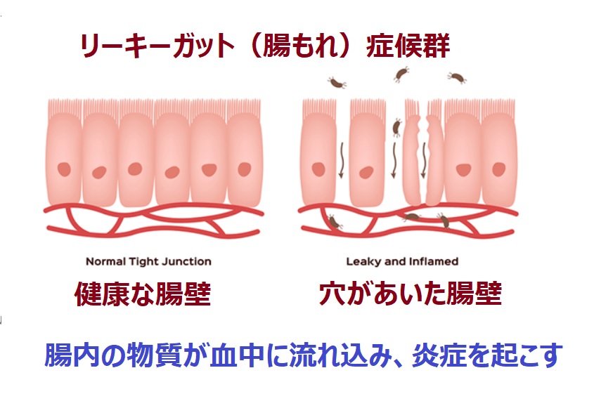 リーキーガット症候群の病態について説明する図