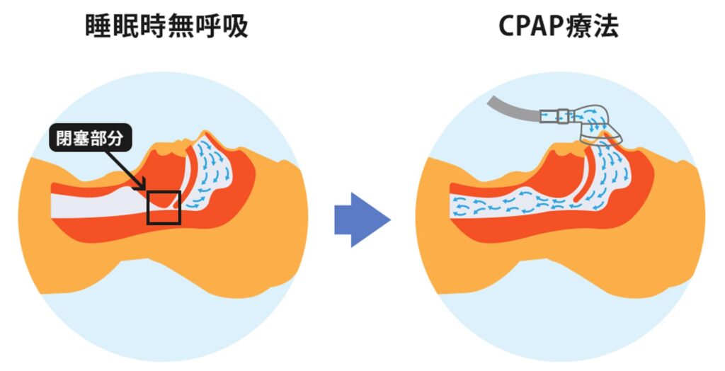 CPAPの器具