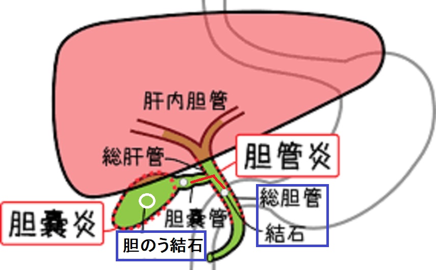 総胆管結石の多くは胆のう結石が流れてきたものであることを示す図