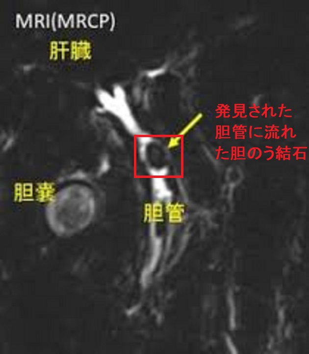 MRCPで発見された総胆管結石
