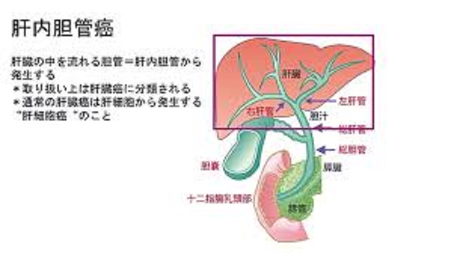 肝内胆管がんについて説明した図