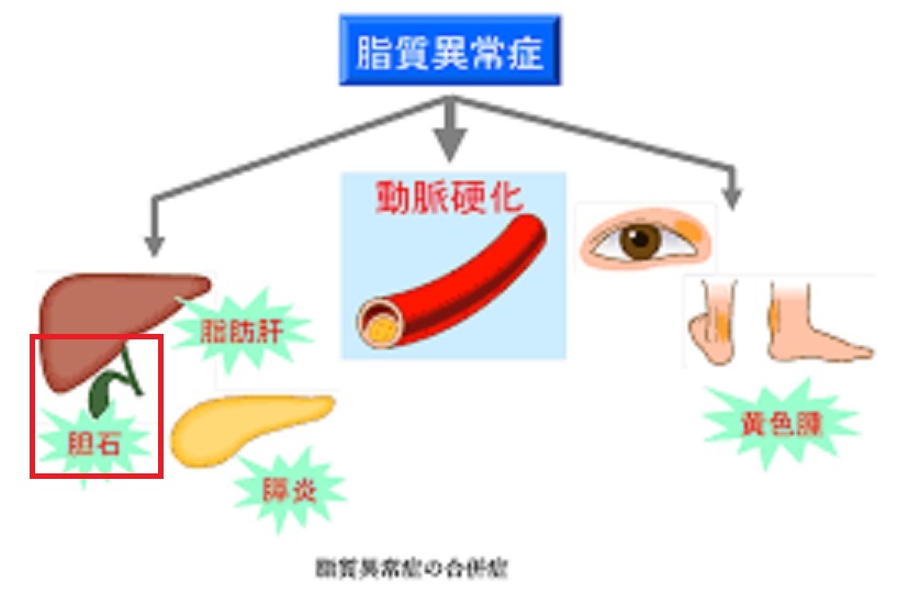 中性脂肪と LDL が高いと考えられるものは何ですか?