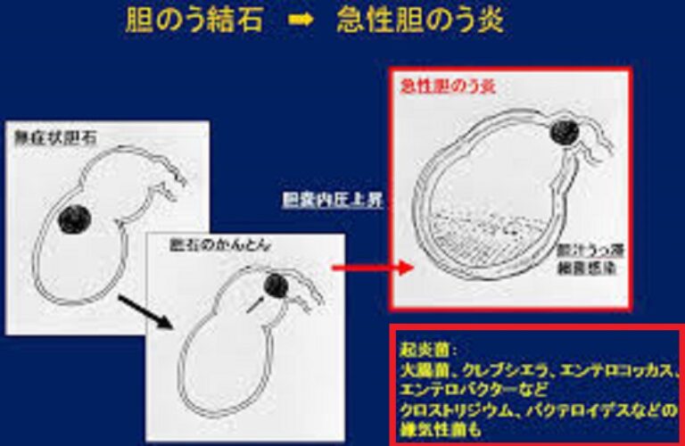 胆嚢炎症を特定する方法