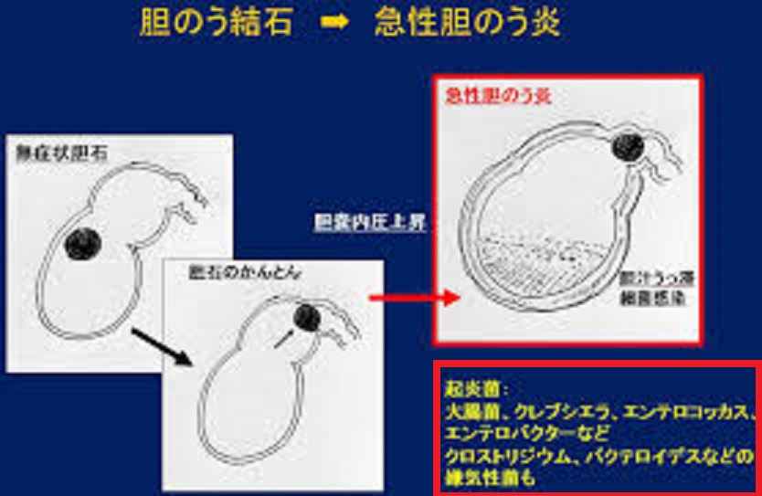 結石性胆嚢炎の症状