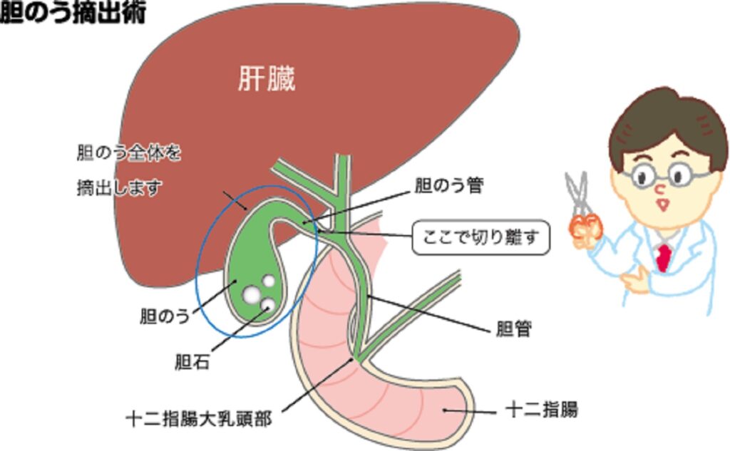 開腹胆嚢摘出の準備方法