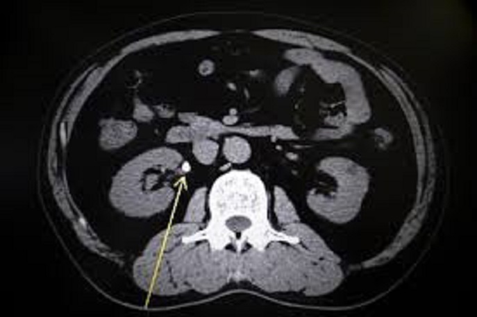 CTスキャン中に予想されること