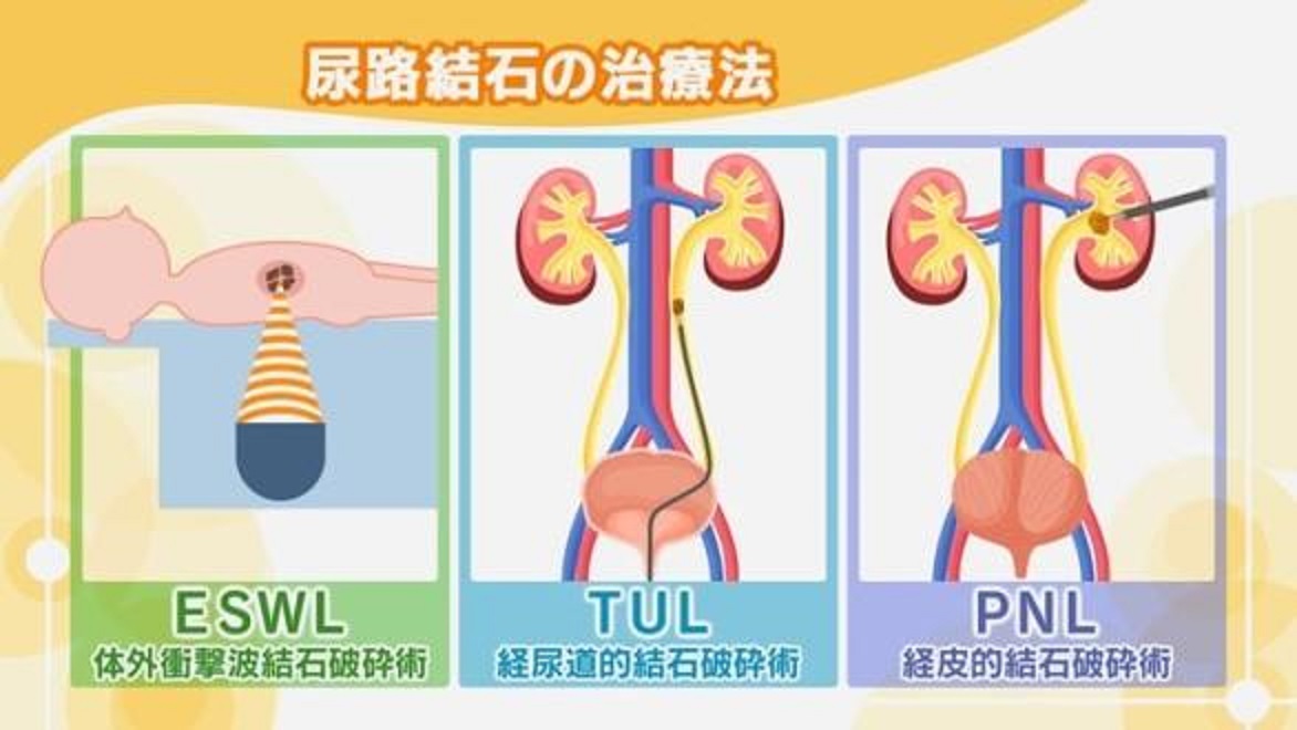 膀胱結石 – 膀胱から石が出ない – Pebble Maths