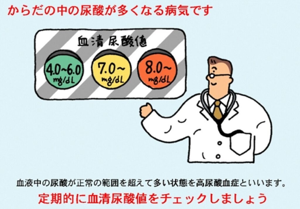 無症候性高尿酸血症からの痛風発作リスクを警告するポスター
