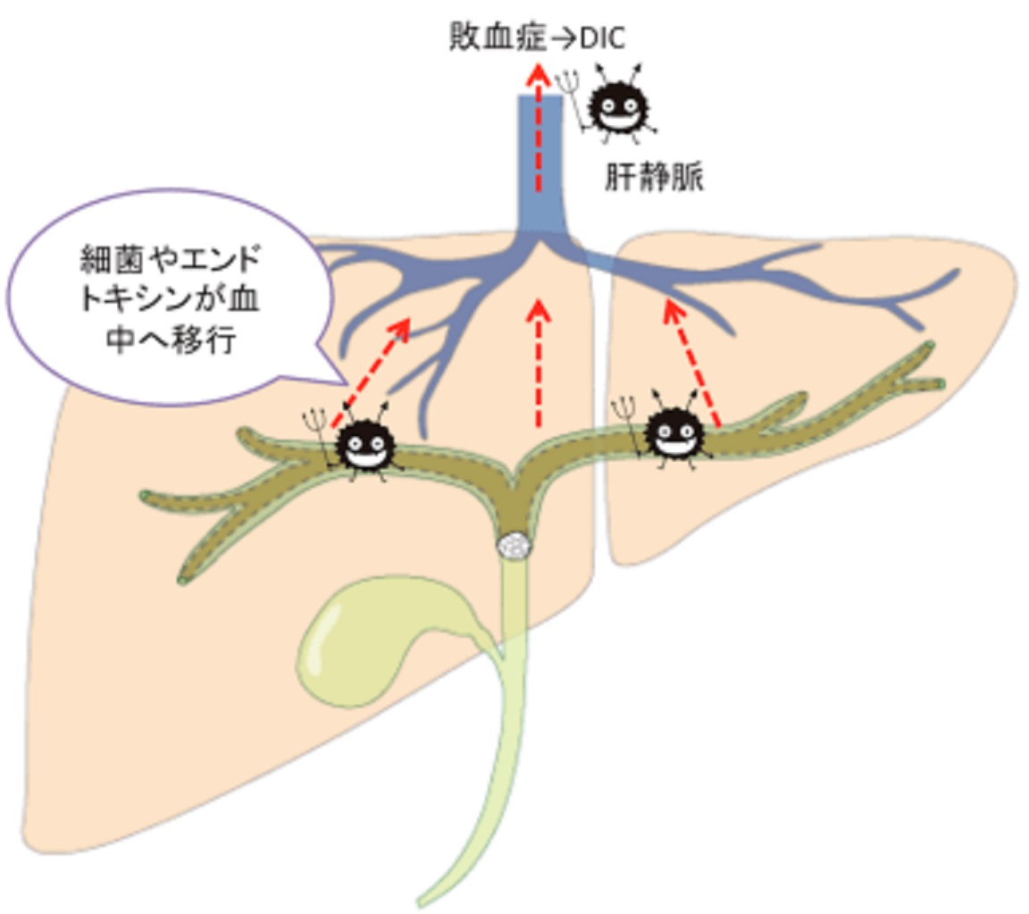 胆石にともなう胆管炎 高橋医院