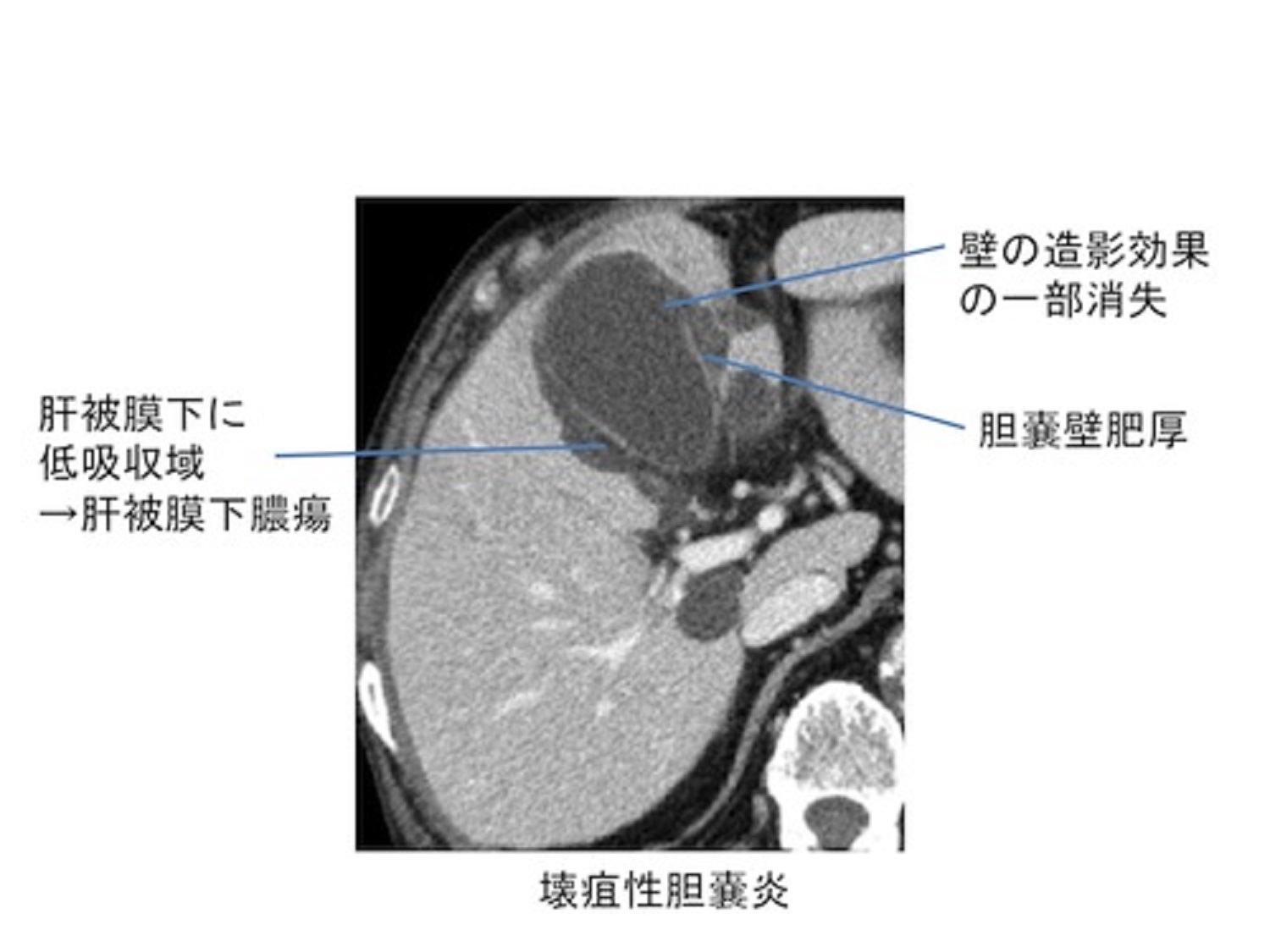 胆嚢炎症を特定する方法